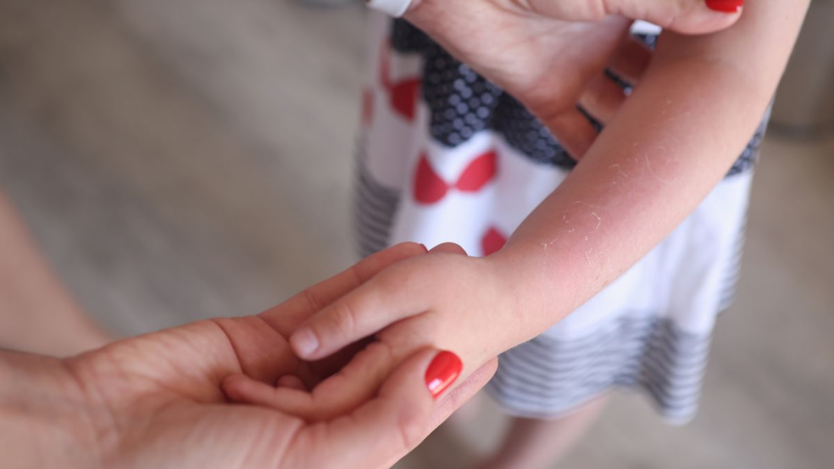 Eczema Treatment for Kids 2 Products We're Using Tinybeans