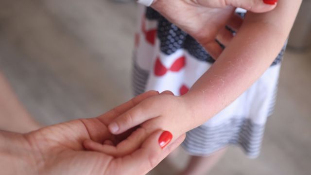Eczema Treatment for Kids: 2 Products We’re Using Right Now